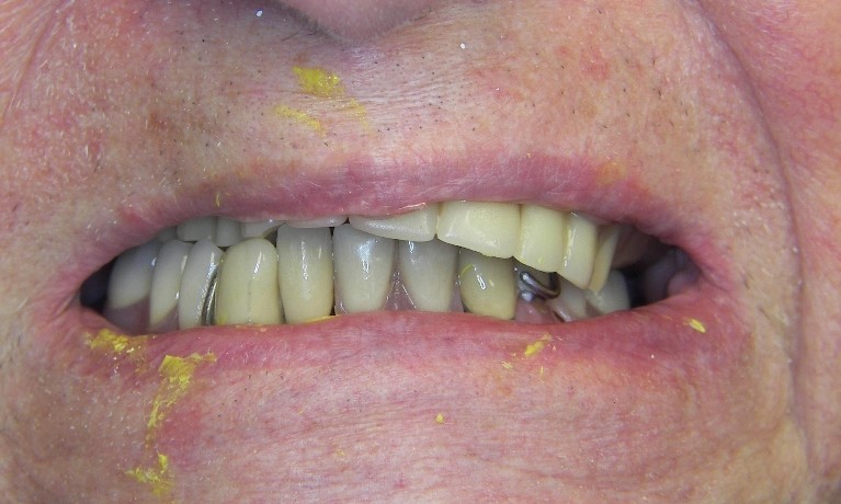 Pink Acid Queen Dentures Nogal NM 88341